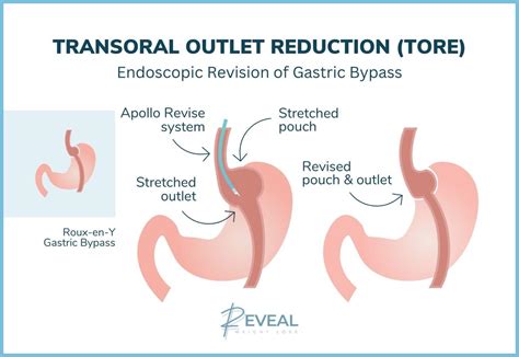 gastric sleeve affordable bay area